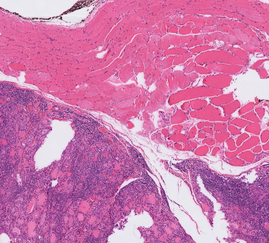 #Everydaythyroid Graves/multinodular goiter/chronic lymphocytic thyroiditis-NORMAL FINDINGS -You could see deposits of thyroid tissue outside of thyroid=parasitic nodules -Important to report them- Why? After total thyroidectomy they may leave tissue behind and if not on