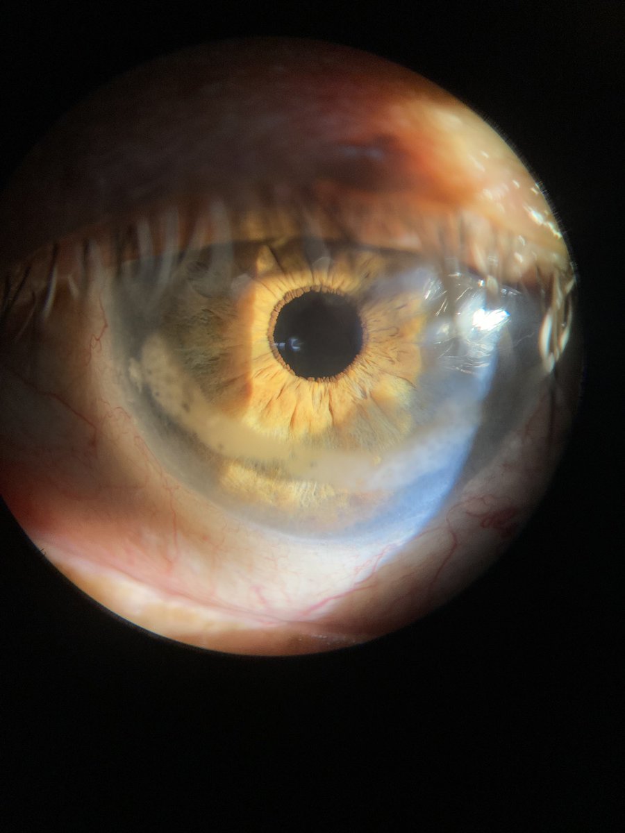 82 year old male with this corneal finding in both eyes.

Spot diagnosis. 

#MedTwitter #MedEd #Ophthalmology #cornea