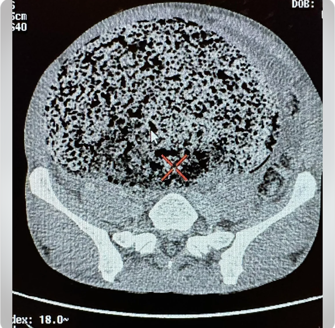 Menuai perhatian, para dokter menyatakan bahwa hal ini menimpa sang pasien karena mengalami sembelit ekstrim hingga fecesnya mengeras dan terjebak di usus besar.

Kondisi tersebut juga dikenal sebagai fecal impaction.

Apabila menghampiri kasus seperti itu, dokter biasanya