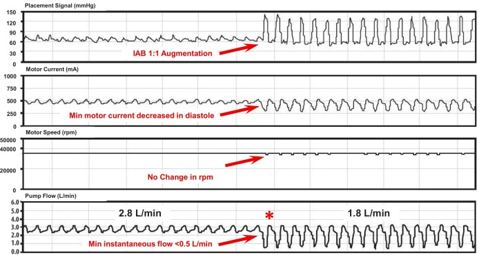 CRMjournal (@crmjournal) on Twitter photo This OPEN ACCESS article was just accepted in <a href="/CRMjournal/">CRMjournal</a>+@ELS_Cardiology!
Combined use of #IABP and #Impella in cardiogenic shock: A systematic review by Jacopo Farina et al.
sciencedirect.com/science/articl… This OPEN ACCESS article was just accepted in <a href="/CRMjournal/">CRMjournal</a>+@ELS_Cardiology!
Combined use of #IABP and #Impella in cardiogenic shock: A systematic review by Jacopo Farina et al.
sciencedirect.com/science/articl…