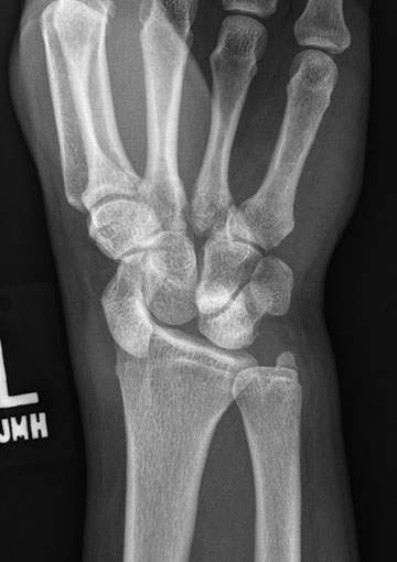 #CaseOfTheWeek...End🎉

📢✅Answer for Case #17: Perilunate dislocation 

Have a great week and welcome back from @ISMRM!!🥳🎉

#FOAMrad #RadEd #MedEd #OrthoEd #OrthoTwitter @ssr_rwg @UWRadRes @HandSociety