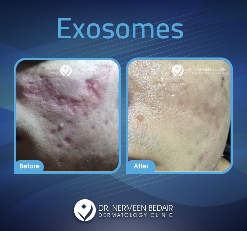 Burn induced scars and persistent erythema.. Four weeks after starting treatment with Exosomes. ندوب واحمرار لا يختفي بعد حرق كيميائي.. ٤ أسابيع فقط بعد بدء العلاج بالاكسوزوم
#exosome #exosomes #burn #scar #erythema #beforeandafter #cairo #dermatologist