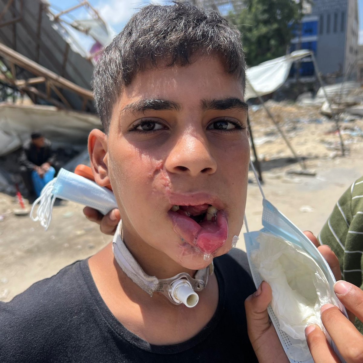 💔🇵🇸 An ISRAELI ATTACK left 13 year old Majd al Shaghnoubi wounded in his jaw and neck. He breathes from his neck and needs urgent medical treatment. NEVER FORGET...