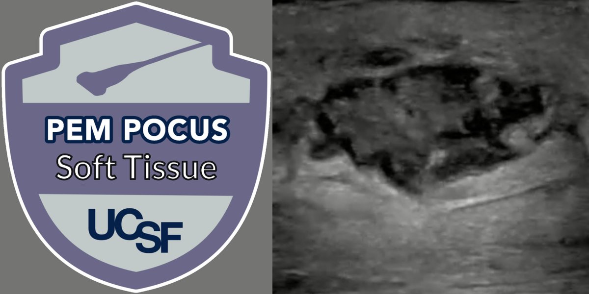 PEM POCUS Series: Soft Tissue Ultrasound Great tutorial on cellulitis, abscess, abscess mimickers, foreign body, and necrotizing fasciitis by Dr. Chiang from @BostonChildrens. Series editor: Dr. @margalinma With a free ALiEMU quiz ALiEM.com/pem-pocus-seri…