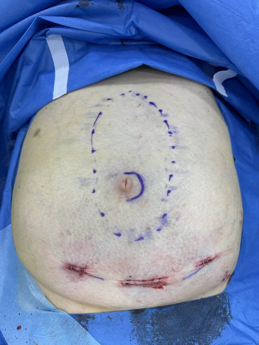 Muy de lunes pero iniciándonos en el mundo de la diástasis de rectos con la técnica REPA. Seguimos adelante creyendo en abordajes mínimamente invasivos de la pared abdominal 👏🏻👏🏻<a href="/AecPared/">Seccion Pared AEC</a> <a href="/Area2Cartagena/">@Area2Cartagena</a>