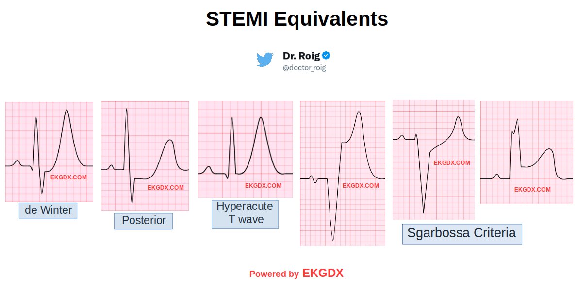1/ Today's 🧵is about 'STEMI Equivalents'. The aim of this thread is to provide a basic guidance on recognizing EKG patterns in cases with coronary artery occlusion where the ST-segment elevation is not present in contiguous leads. Based on the expert consensus published by the
