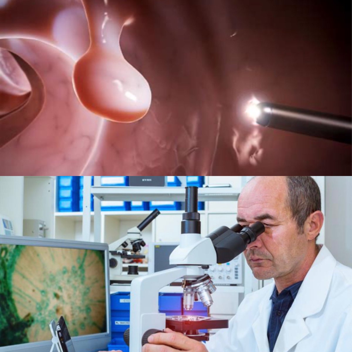 “ with every single colonoscopy, they suck a little piece of normal bowel wall into the scope, snip off the healthy tissue, and send it to the lab. They call it a polyp and bill thousands $$$$ . Since the pathologists get paid just to look at the specimen, they always say the