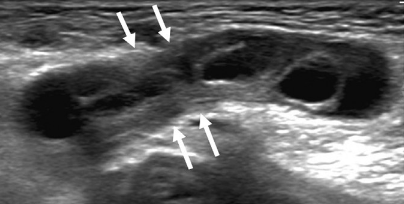 Painful palpable groin mass. What is the diagnosis?
