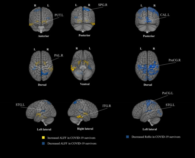 Brain abnormalities in survivors of COVID-19 after 2-year recovery: a functional MRI study ❗We’re now at TWO years…… if anybody still thinks that this will resolve in the further future..….😢 and what now with multiple C19 infections? ➡️Post 'MILD' C19 included! ➡️'This…