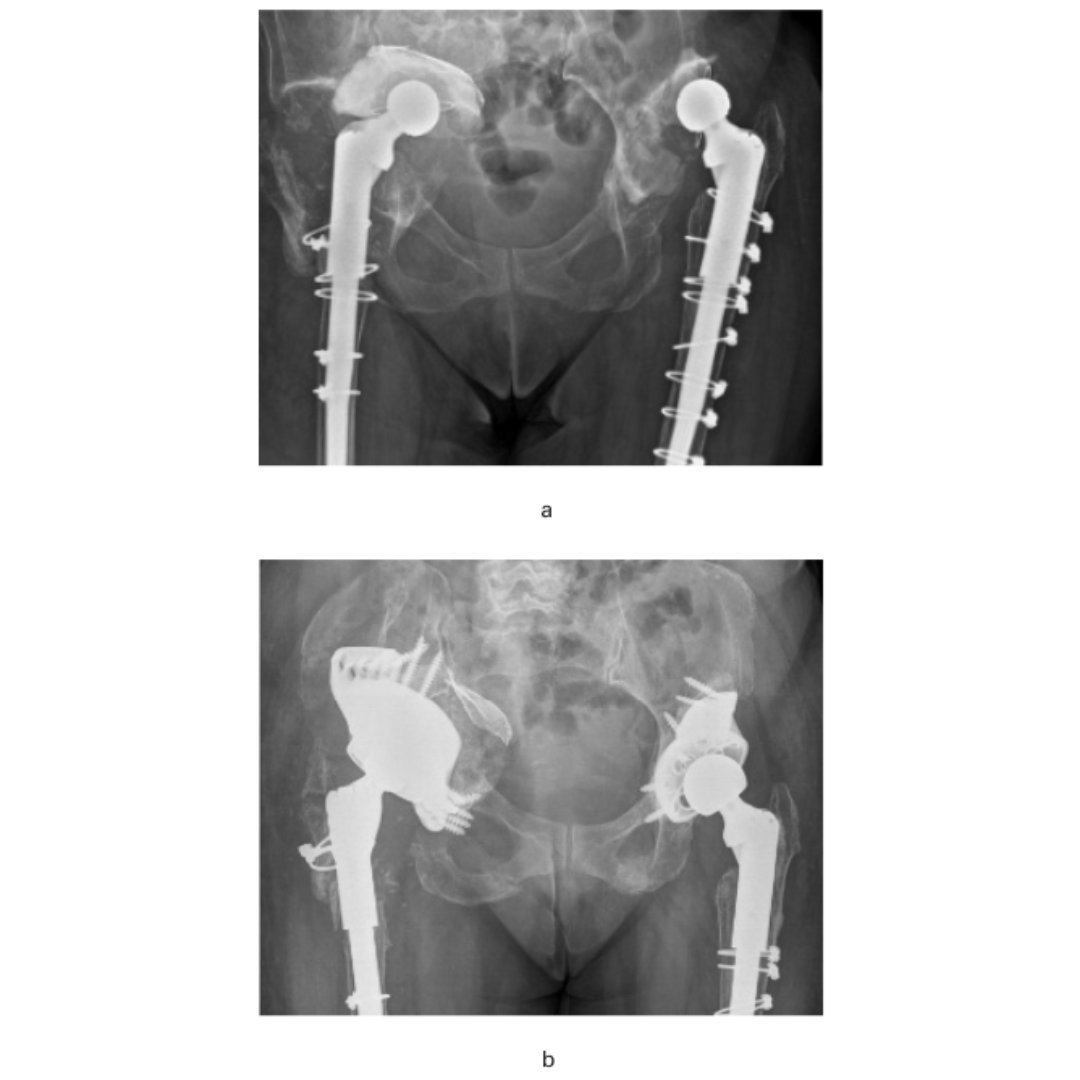 The challenge of achieving a reliable outcome for patients is even greater in the setting of major acetabular bone loss. The structured approach of a treatment algorithm can simplify these problems. #BoneLoss #Surgery #BJJ @saustinjones ow.ly/ASn250RuJve