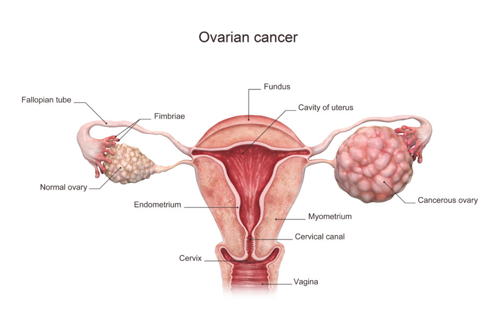 7 tips to prevent cancer of the ovaries

1. Give birth: become a mother.
2. Breastfeed: especially your child.
3. Don't use talcum products: completely avoid.
4. Exercise regularly: at least 3 days/week.
5. Don't smoke: all kinds of smoking.
6. Avoid alcohol: zero alcohol is…