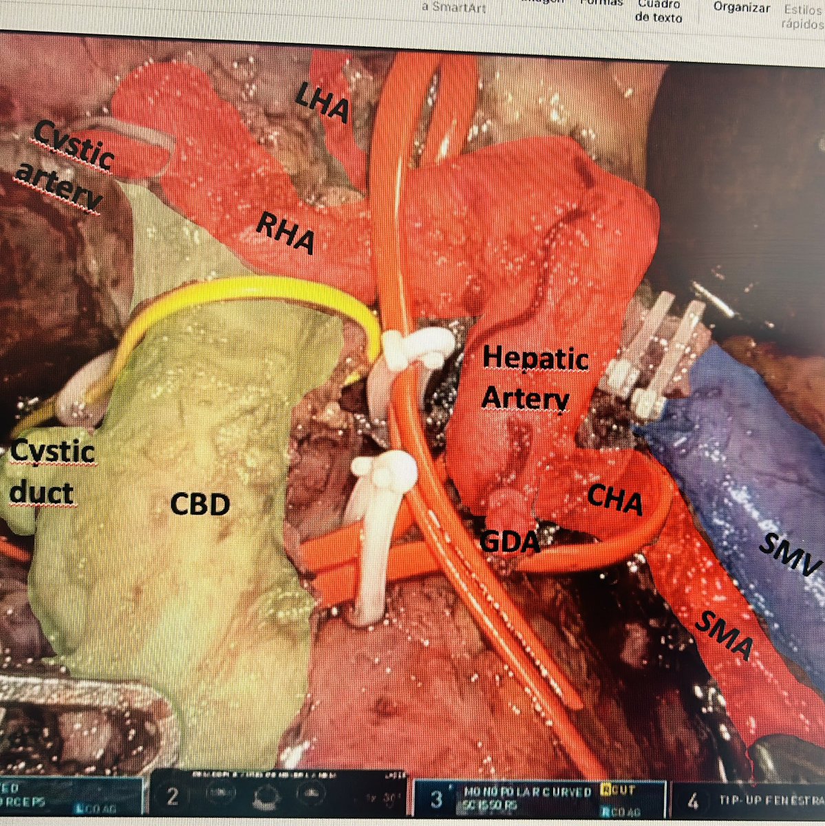 HpbMar's tweet photo. Minimally Invasive #Pancreaticoduodenectomy 

🔥 Mesopancreas Dissection
🔥 SMA dissection 

Challenging steps of this procedure 🥊
Any chance to make it safer?

I’ll be waiting you at 📍Cap Town next Thursday at the #MasterVideo session of the @IHPBA meeting 
@Gio_Marchegiani https://t.co/RycojQMlAh