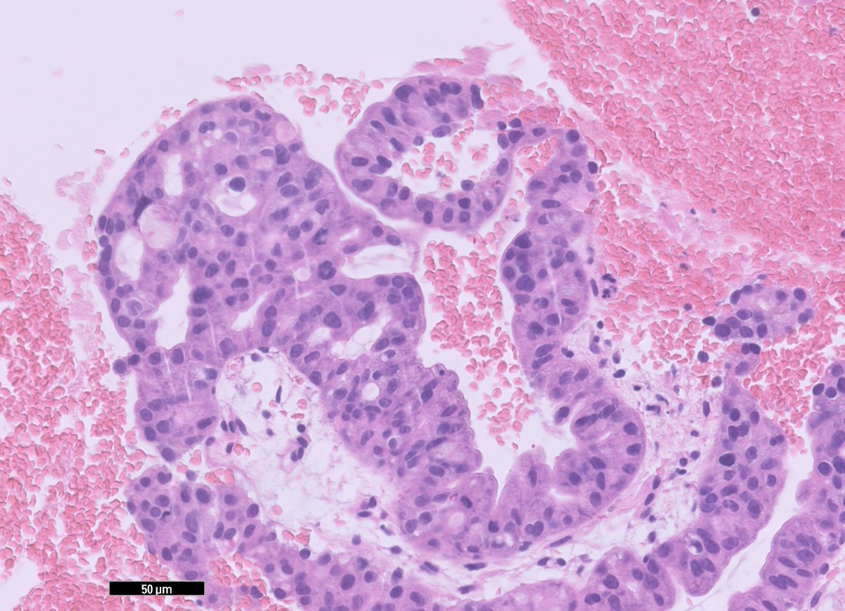 FNB material 30mm complex cystic lesion head of pancreas (historic case)