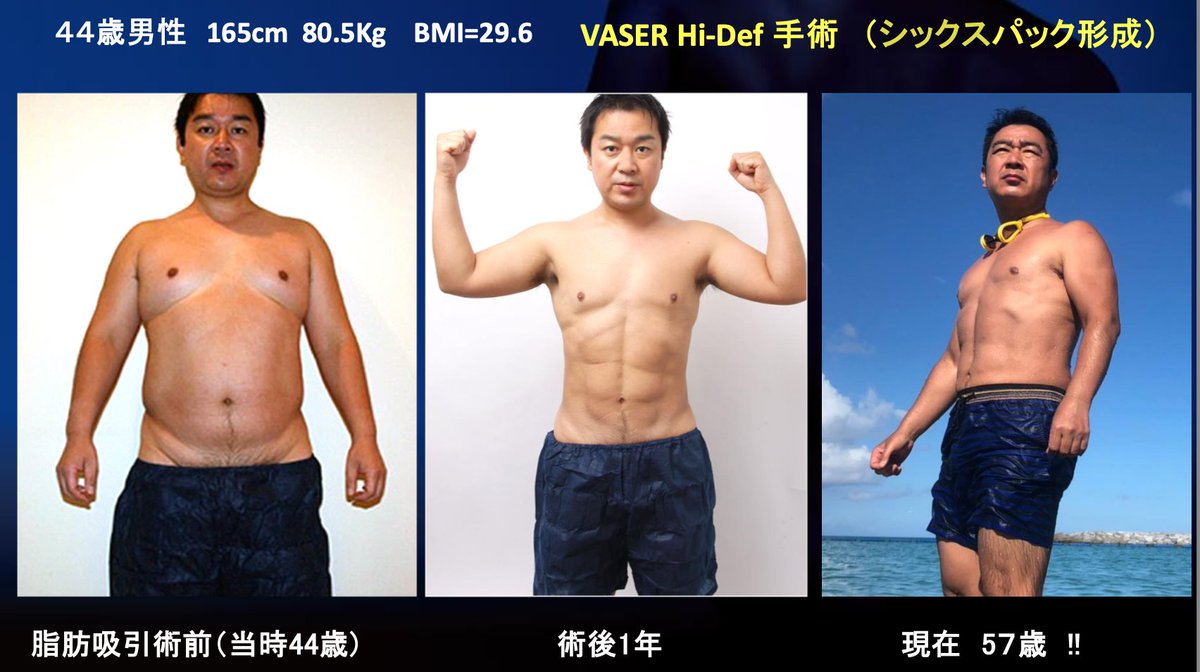 高須 クリニック 腹筋