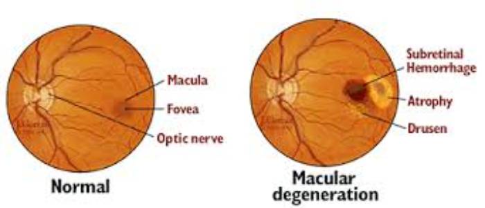At least 30 crore people could be victims of serious eye disease by 2040

Presently the number is 20 crore

Smoking, #Hypertension, #Obesity are the causes of this disease

Click to read as to how to prevent this disease : sanatanprabhat.org/english/101322…

#HealthTips
