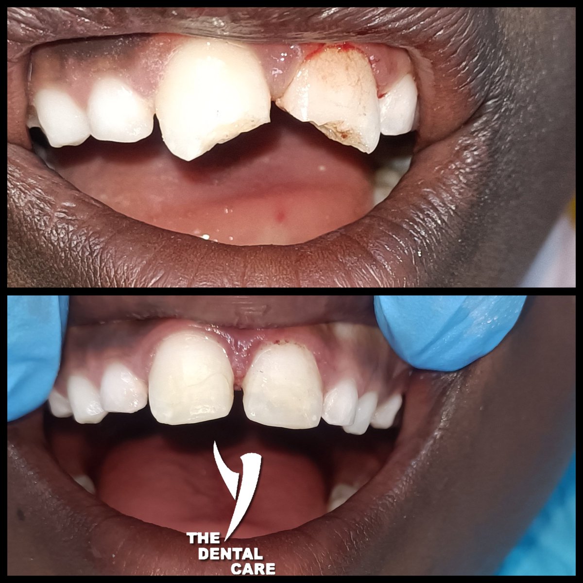 Mondays can be tough, but let's send some positive vibes to the boy who fell and fractured his teeth. Wishing him a speedy recovery! 💪 #MondayMorningBlues #GetWellSoon sekodental.co.za