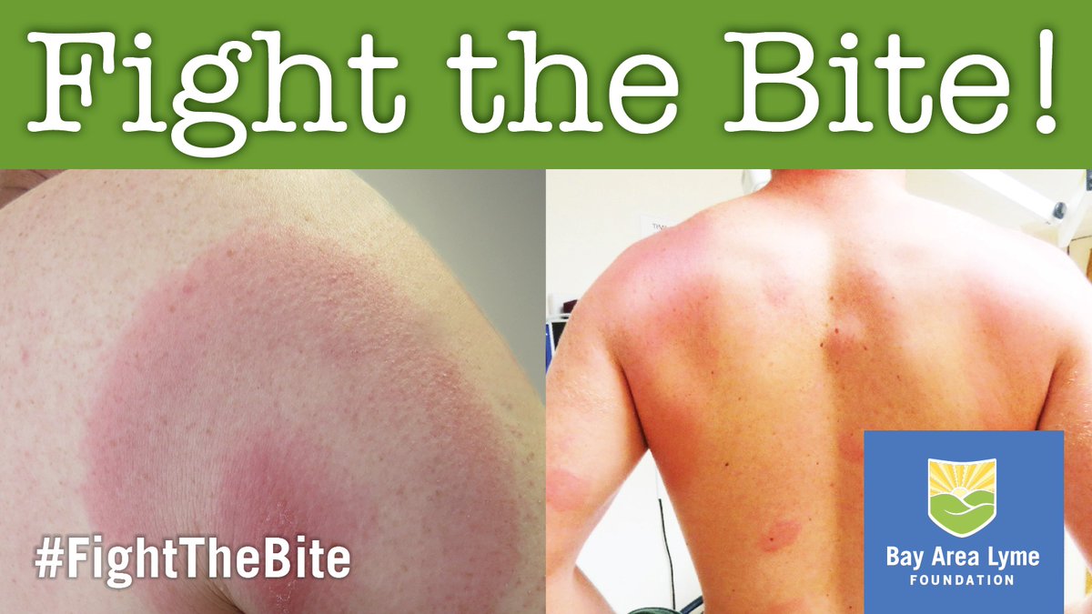 LDAM FACT: While the classic 'bullseye' rash can be a sign of #Lyme, not all Lyme rashes exhibit this pattern. Only abt 20% of infected persons get a “bullseye rash,” although up to 80% may have a rash of varying shapes.⬇️ bit.ly/3UBBWFd #LymeAwareness #FightTheBite