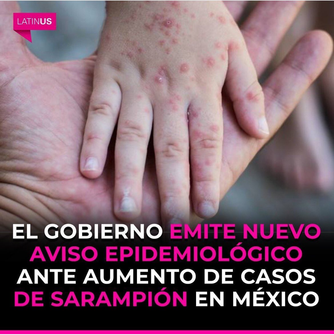 El Sarampión, la tosferina y la polio ya estaban erradicadas en México y con la criminal negligencia del #NarcoPresidenteAMLO59, resurgieron estas enfermedades, poniendo en riesgo la vida de nuestra niñez, para desviar el 💰 a donde solo ellos saben. 
😡😡😡