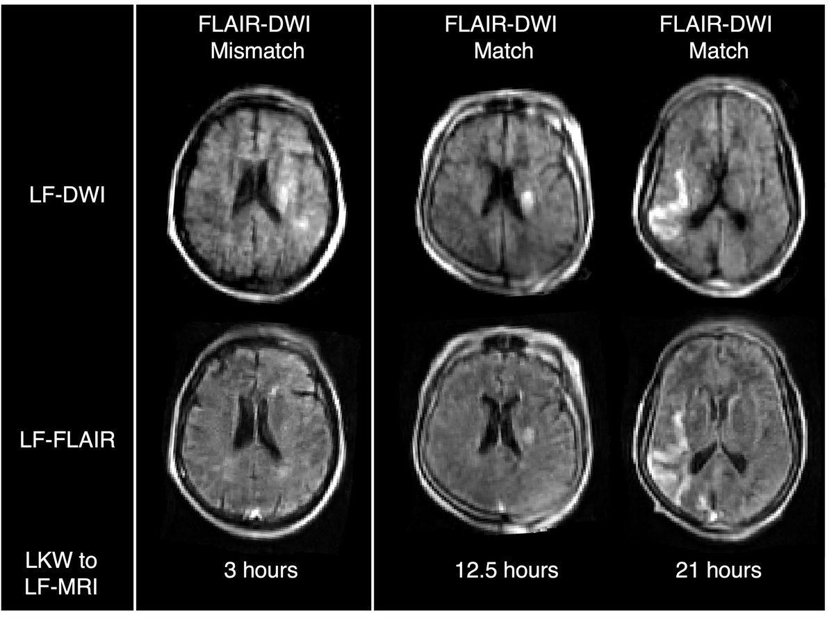 Our experience detecting DWI-FLAIR mismatch on portable low-field MRI for acute ischemic #stroke out now in @ANA_journals doi.org/10.1002/ana.26…. Thanks to our incredible co-authors for their collaborative effort! @MGHNeuroICU @MGHNeuroSci @harvardmed