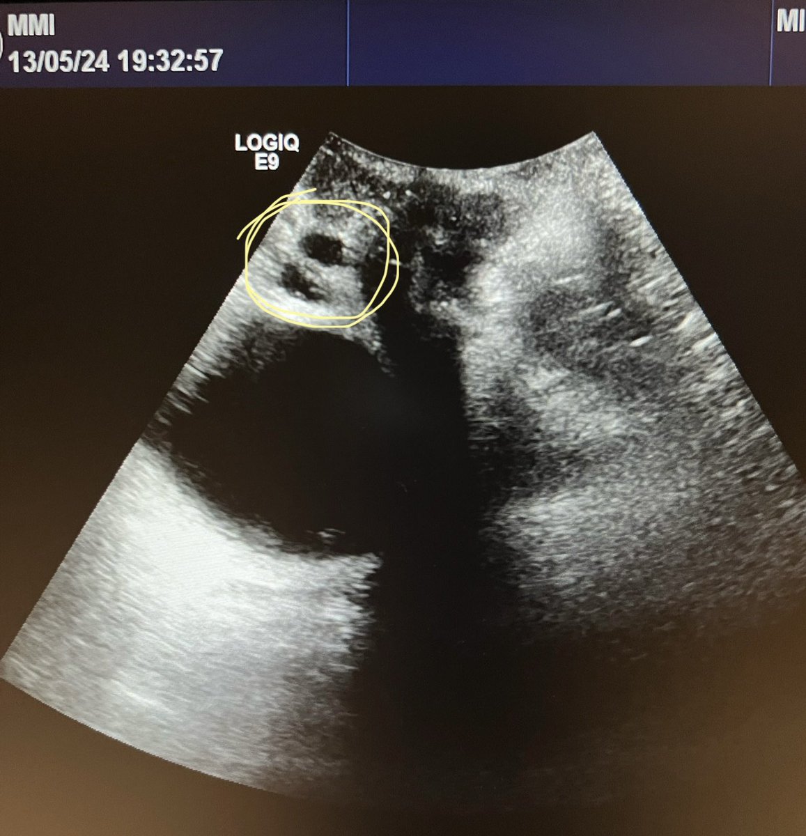 Clinical utility of bedside US illustrated : It corrected an inaccurate history by the patient of ‘recent Botox 💉’ but in fact it was bulking agent (Bulkamid is 96% water so is hypoechoic). She never had Botox. This changes how I manage her. More urol should learn bedside US