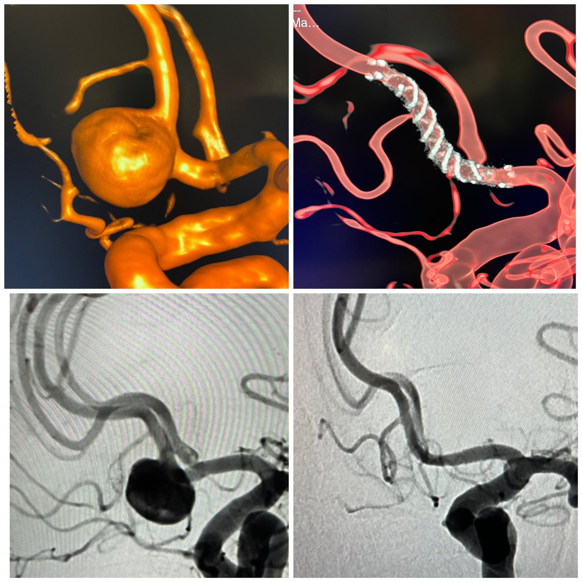 Lots of different options for patients with anterior communicating artery #aneurysms depending on exact location/shape/size etc. Here a beautiful result for this A1/2 junction sidewall aneurysm on 6mo FU using FredX 21 #flowdiverter #SuperDyna @MV_Terumo @SiemensHealth @PennNSG