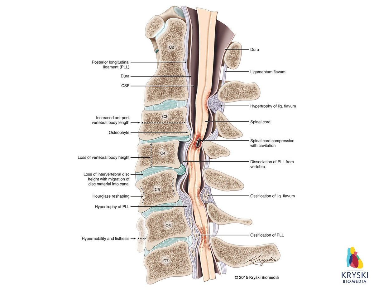 This illustration by @kryskibiomedia depicts a sagittal cross-section of the multiple anatomical changes that may present in the cervical spine of patients with degenerative #cervical #myelopathy. Explore more: buff.ly/3fb0QHg #orthopedics #spine #anatomy #sciart
