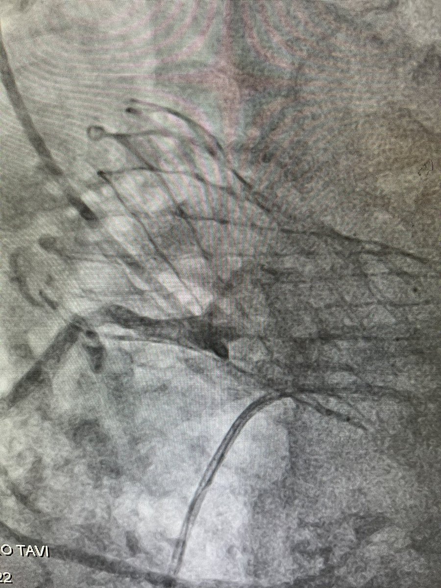 Evolut Fx Plus has arrived!

Large windows for coronary access. 

Watch the first case recorded live on OPCI.live this Saturday 

<a href="/StFrancis_LI/">St. Francis Hospital & Heart Center</a> <a href="/OPCILive/">OPCI</a> <a href="/ziadalinyc/">Ziad Ali</a> <a href="/djc795/">David J. Cohen, MD, MSc</a> #richierich