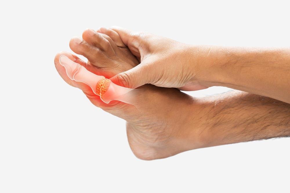 Symptoms of Tailor’s Bunions

We want to start by noting that symptoms can vary in severity, with some individuals experiencing mild discomfort while others may face significant pain and mobility issues. Still, the most common symptoms associated ...

midpennfoot.com/what-is-a-tail…