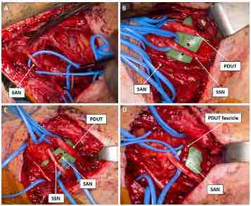 #JNSCaseLessons: An illustrative case of selective upper trunk posterior division fascicular nerve transfer for proximal spinal accessory neuropathy thejns.org/caselessons/vi…