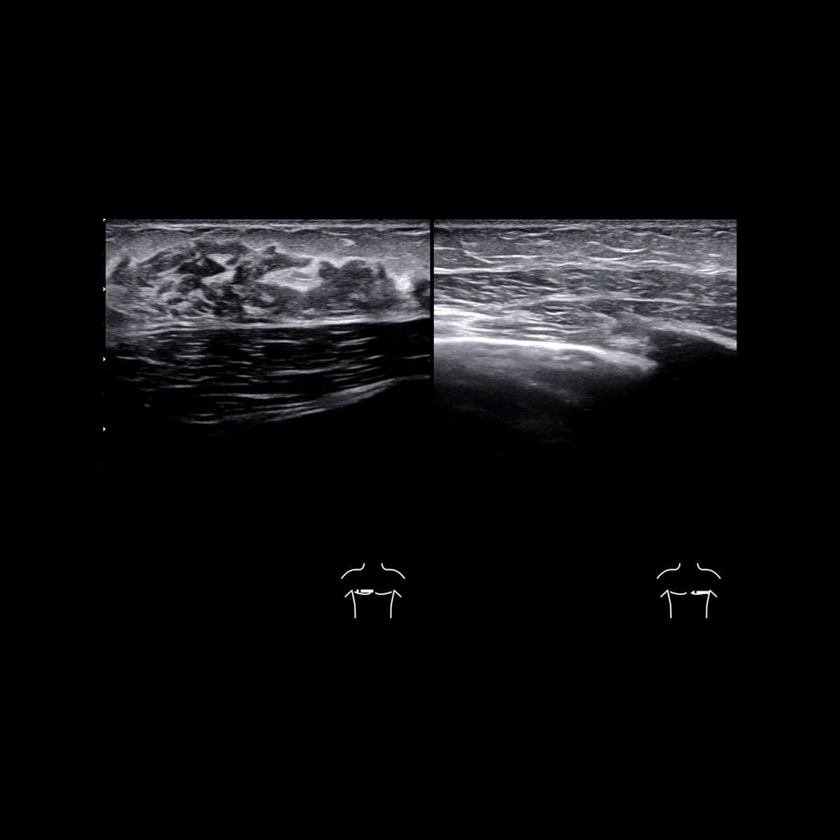 Male school ager with palpable mass underneath nipple in right breast

Transverse US of right breast(left) shows retroaerolar, primary hypoechoic mass in subcutaneous breast tissue

#FOAMed #MedEd #FOAMPed #FOAMRad #PedsRad #RadEd #RadRes #radiology #PedsPulm #FOAMus #Ultrasound