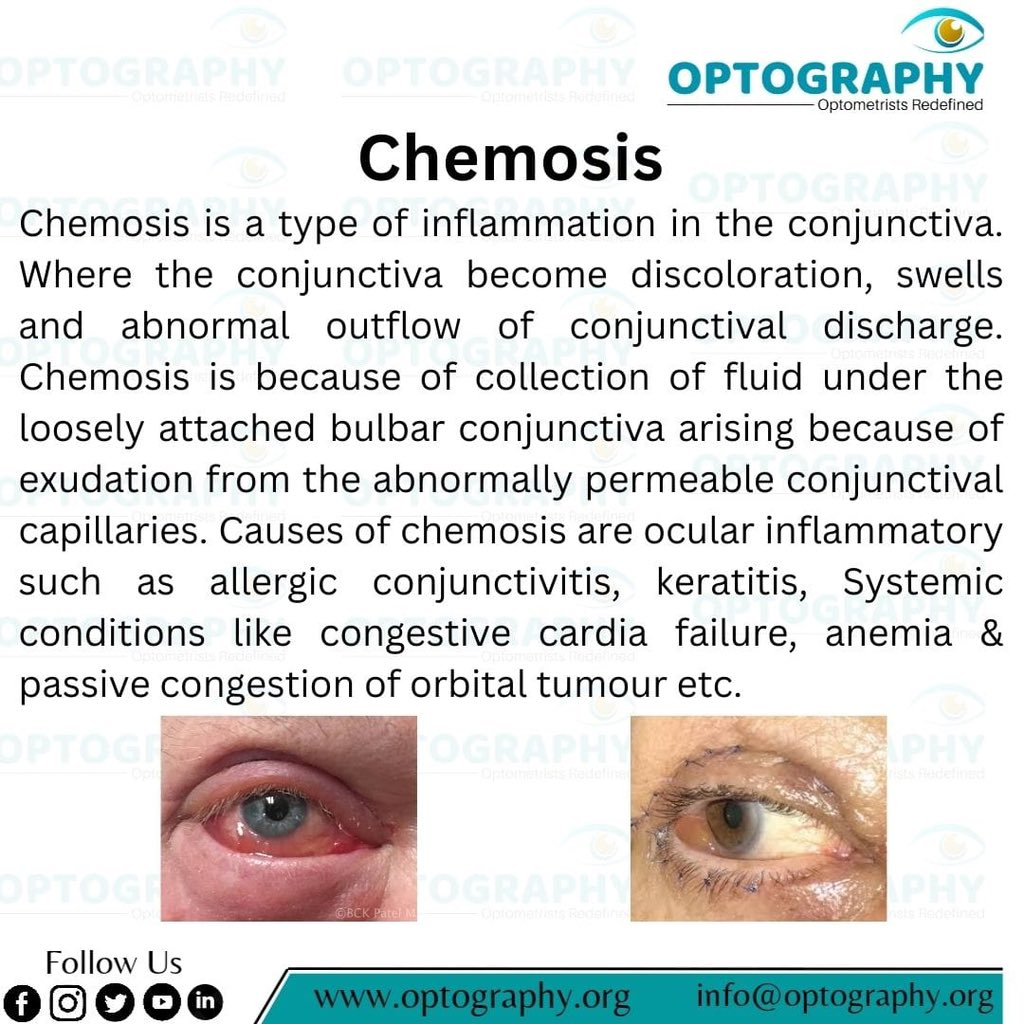 #Chemosis #Eyeshealth
#Conjunctivitis #Allergic
#Optometrist #Optography