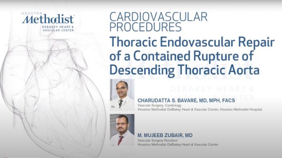 Minimally invasive repair (TEVAR) for a contained rupture of descending thoracic aorta resulting in tracheal compression. Important to be familiar with steps and techniques of TEVAR in this day and age m.youtube.com/watch?v=Hlhezm…