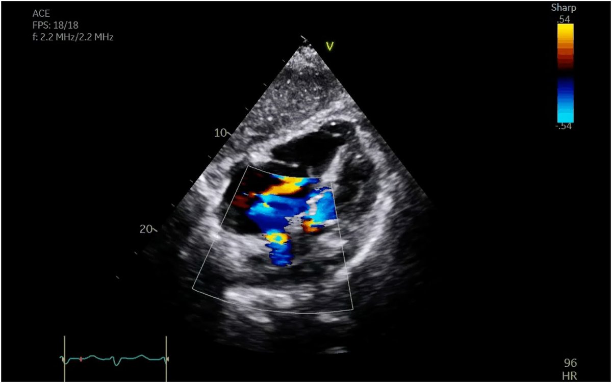 🌟 #CoolCaseOfTheMonth: A case of refractory hypoxemia secondary to intracardiac shunt – initial echocardiography. Read the full #CaseReport in #CJCO 👉 cjcopen.ca/article/S2589-… 🌐