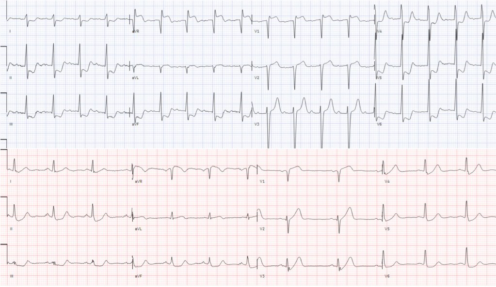 Two patients with diffuse ST depression and reciprocal ST elevation in aVR: do either/both/neither have Occlusion MI? hqmeded-ecg.blogspot.com/2024/05/two-pa… @ECGcases