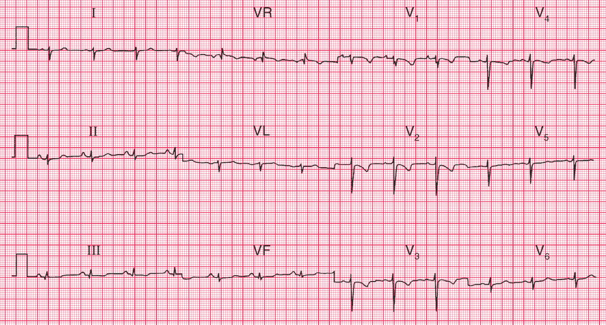 A 32 y.o. woman, normal pregnancy and delivery 3 months previously, presented with severe breathlessness and dizziness on exertion. She had bilateral pleuritic chest pain.
- What's the Diagnosis ?  

➡️ Answer and Interpretation: manualofmedicine.com/ecgs/ecg-case-…

#medtwitter #foamed