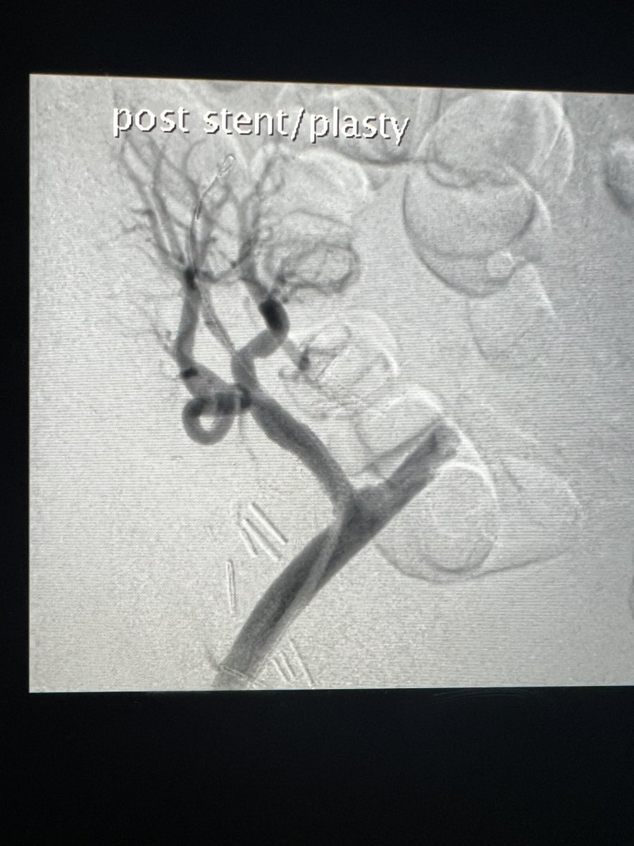 There’s something very satisfying about these cases. In thin patients, I like dialysis access sheath for short ipsilateral access with balloon expandable bare metal stent. Case done with 5cc contrast total and #transplant function improved