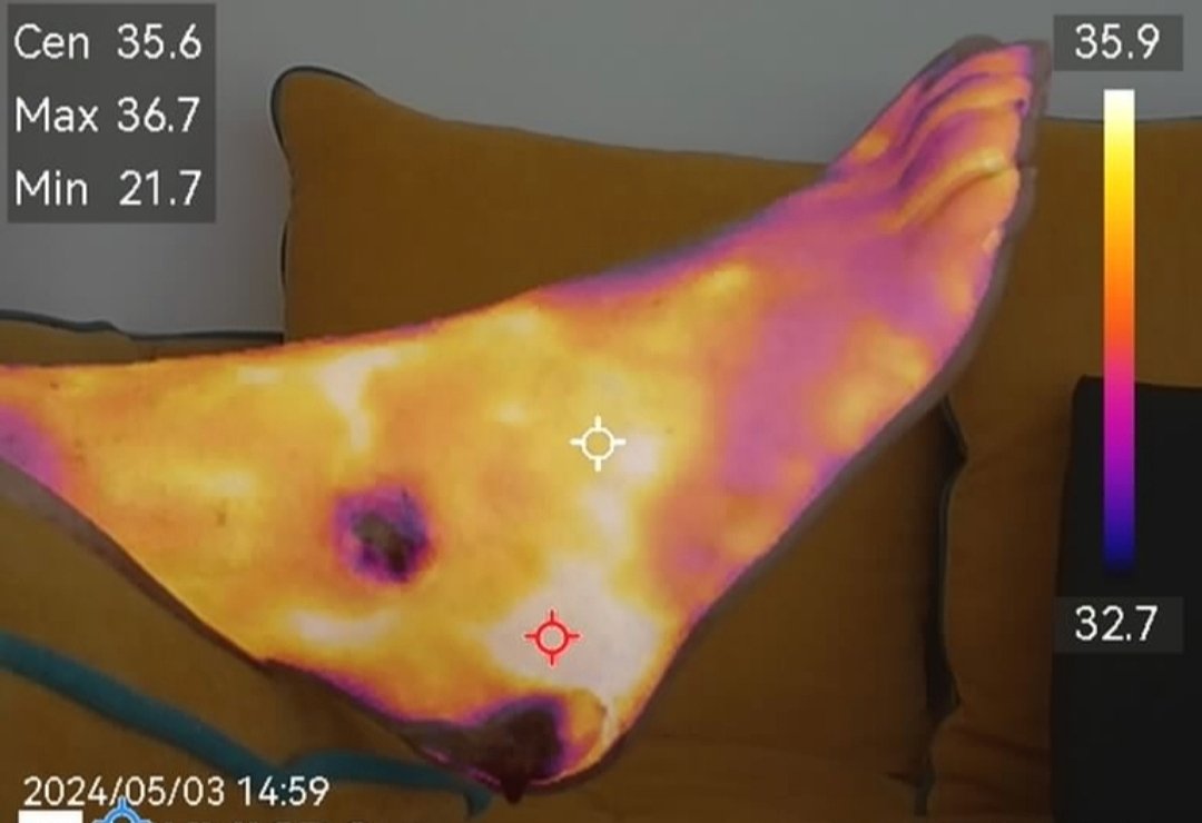 Uso de fomentos de octenidina para combatir bacterias multirresistentes + apósito de cobre para mantener actuación antimicrobiana y ayuda en la regeneración tisular, acompañado de compresión terapéutica para mejorar la circulación a nivel venoso y talonera de aire