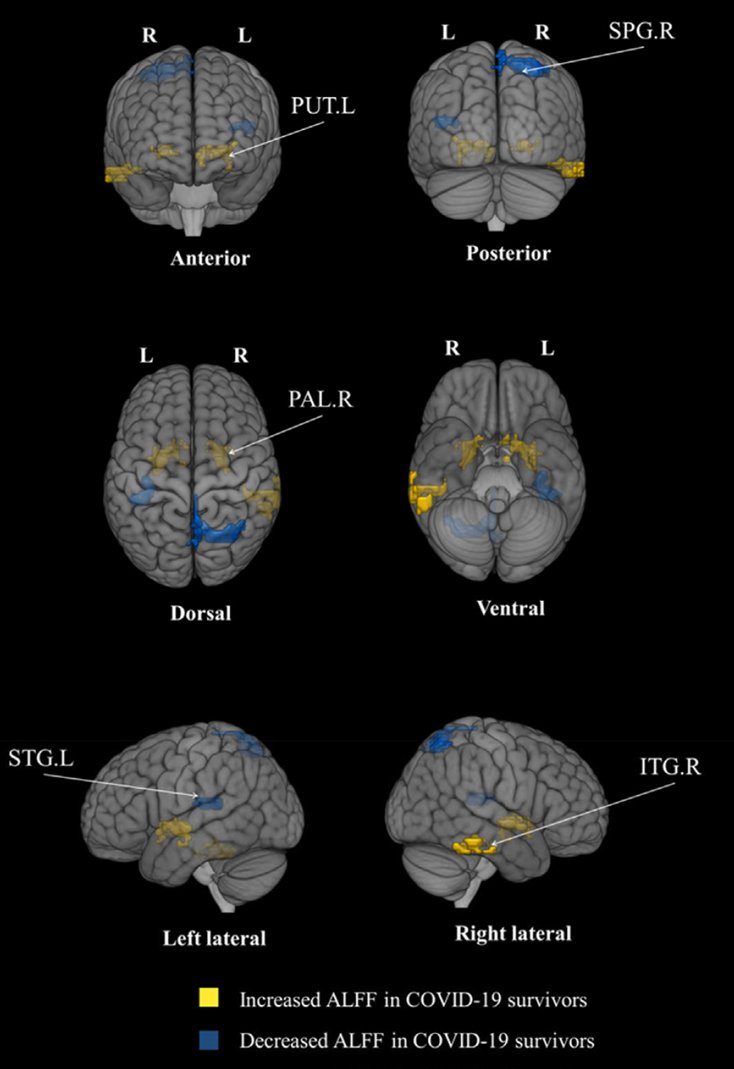 Brain abnormalities in survivors of COVID-19 after 2-year recovery: a functional MRI study - A 2-year follow-up imaging study indicating ongoing alterations in the putamen, temporal lobe, and superior parietal gyrus. - Cognitive failure, general fatigue, and neurological