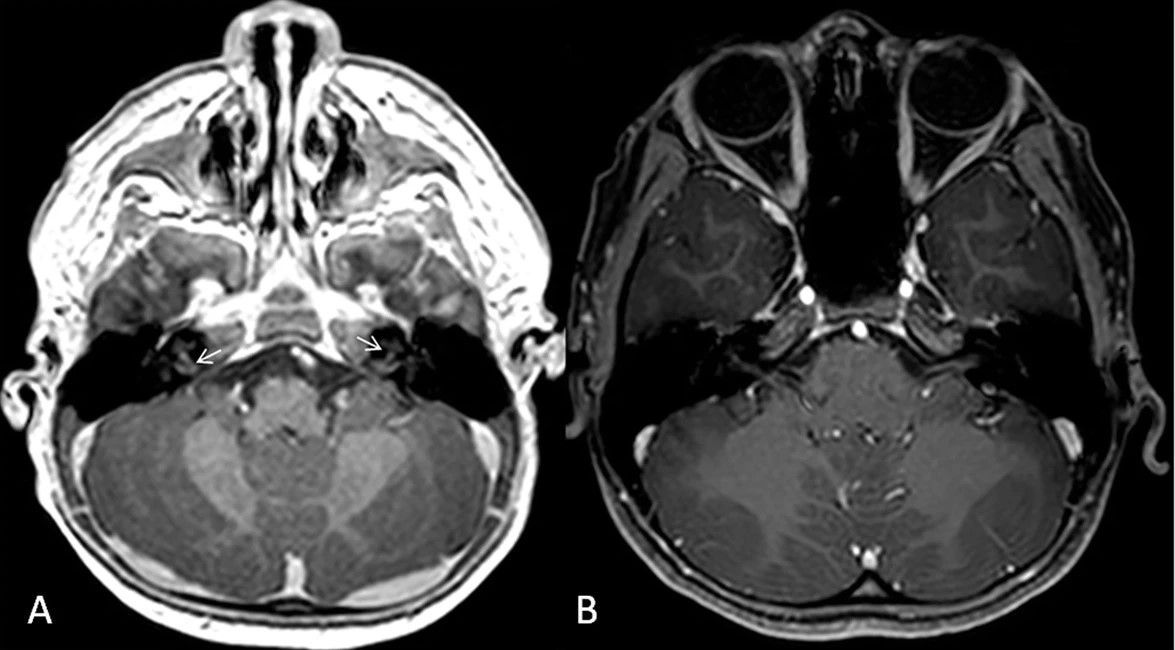 Educational Review: Monogenic autoinflammatory diseases in children - single center experience with clinical, genetic, and imaging review. (Alaa N. Alsharief et al.)

#InsightsIntoImaging

🔗 buff.ly/3wsU1Nr