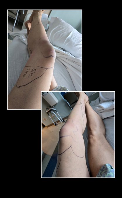 Circled areas are where the infection is 😔 https://t.co/4p7vn0CMj9<a href="/tag/angelakeno"class="tags"><span>#angelakeno</span></a>