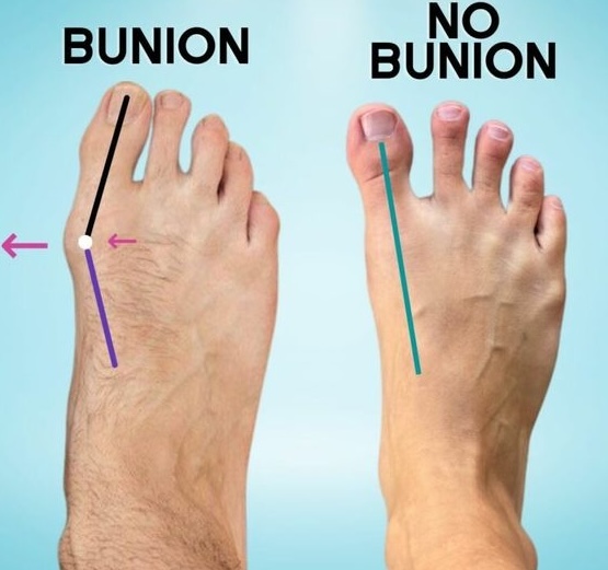 Hello fellow bunion warriors! 👣 In my 20s too and finding relief in new balance shoes while attempting to rock flipflops daily. 🌟 Any tips on shoe shopping for our bunion buddies? Share pics of your bunion journey… halluxcare.com #bunion #bunionpain #tailorsbunion