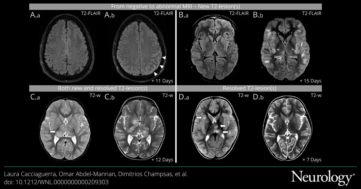 This multicenter study explored the acute dynamics of brain MRI features of #MOGAD within a single attack and demonstrated 3 major findings. Read the article to learn more: bit.ly/3WtFMCN