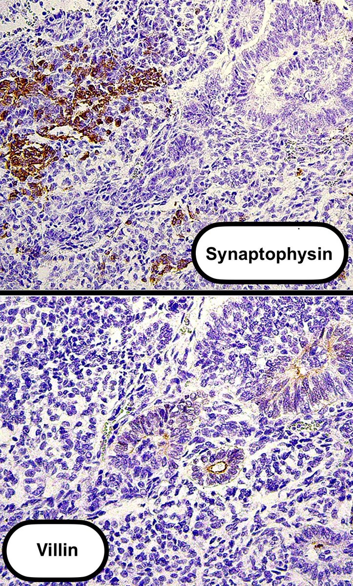 The optimal immunohistochemical panel for distinguishing the components of embryonic-type neuroectodermal/glandular complexes includes stains for: Synaptophysin, GFAP, villin, and AFP #GUPath #IHCpath #testiscancer Article: tinyurl.com/Whaley-Ulbright