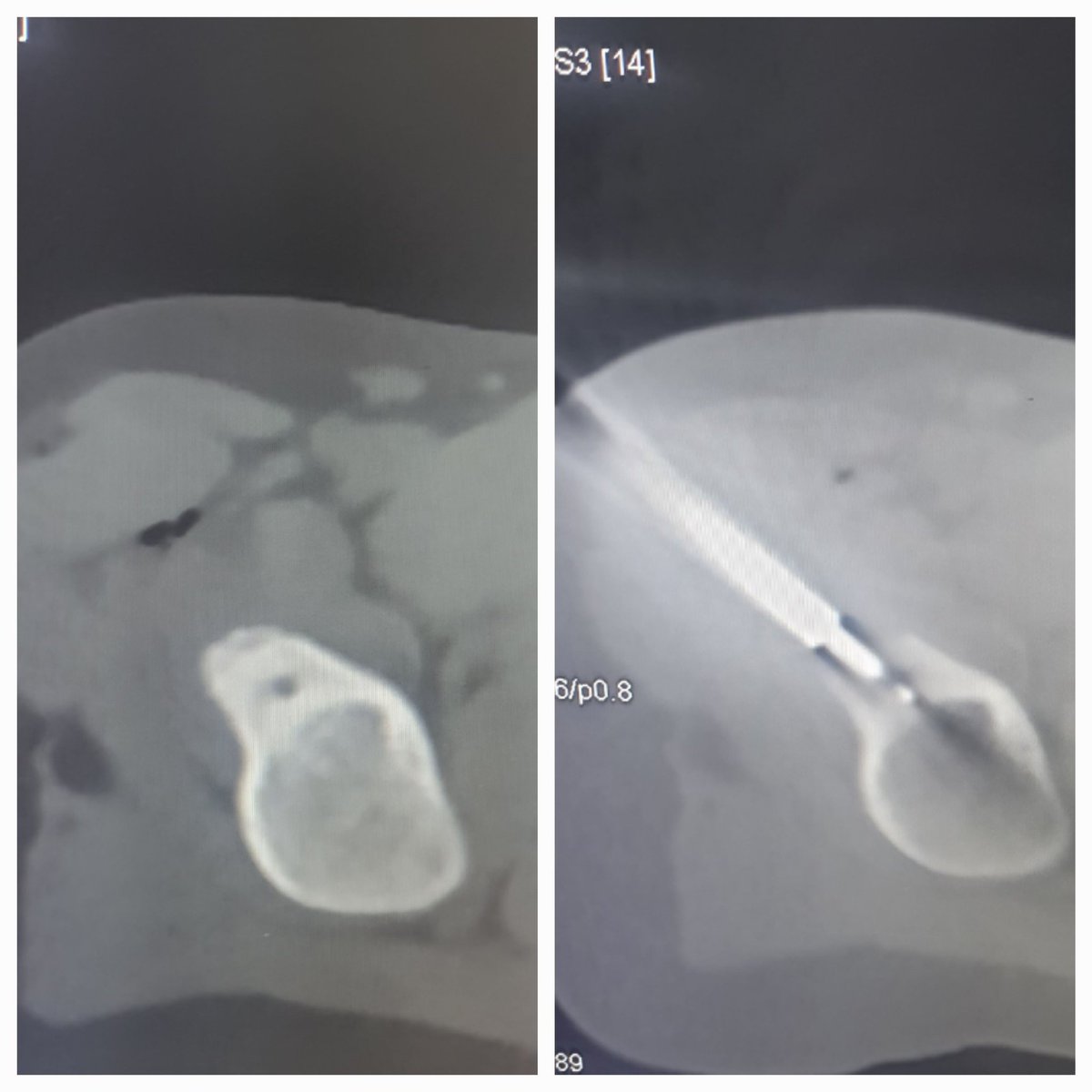 Dr Saurabh kumar Interventional radiologist tweet media