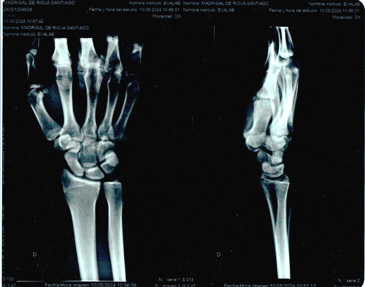 Buenas noticias! 
Esguince en la muñeca derecha y descartamos cualquier lesión de mayor gravedad a nivel óseo. 😅
Rápida pasada por talleres y vuelta a los últimos entrenos preparativos para la Copa del Mundo de Madrid que se celebra este fin de semana 🏠.
Intentaremos llegar! 🙏🏻