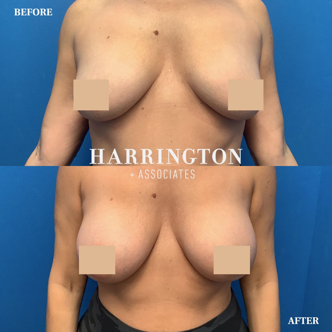 DoctorJenn_HPS's tweet photo. Results from 4 months post Breast Augmentation with 285cc silicone implants by Dr. Harrington! https://t.co/k3WYj2jHDK