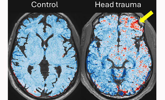 Dal scientists find repeated, small hits to the head in football players can damage blood vessels in the brain: bit.ly/44JANzN