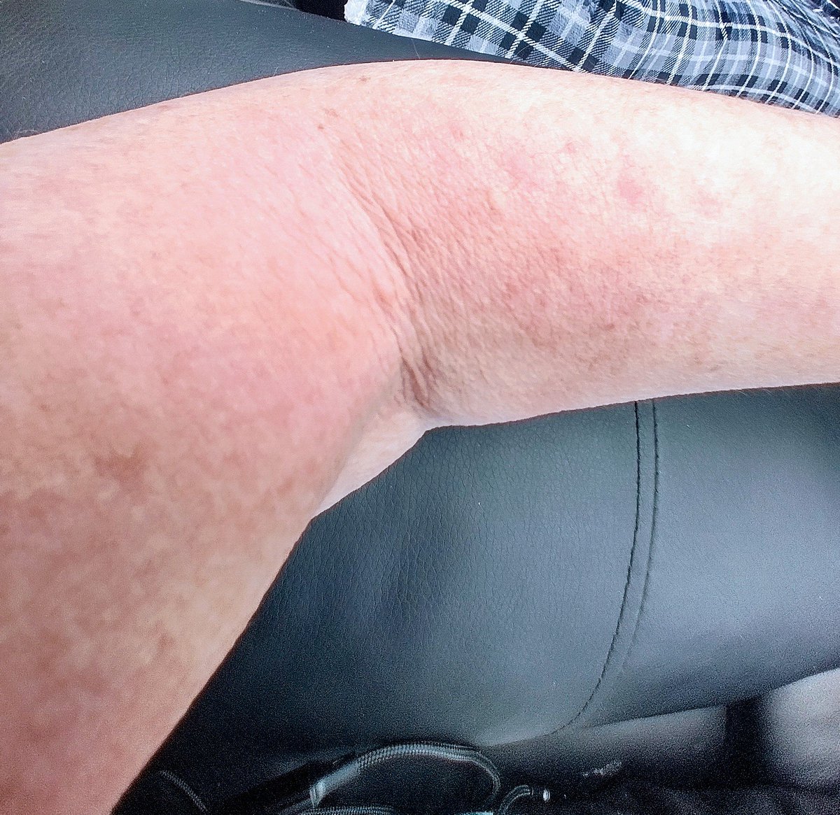 For the few blimmin minutes I was in the sun today 😩 I sit in the shade to be safe. Rash is driving me nuts, non stop itching 😩. Tried every cream ever invented. Anyone have tips or remedies? #sunallergy #dracula