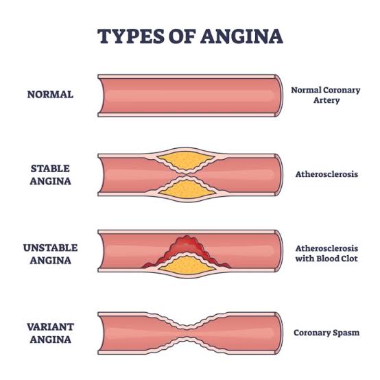 دل کی بیماریوں میں سے ایک عام بیماری انجائنا ہے، جس میں دل کو خون فراہم کرنے والے عروق کی رکاوٹ ہوتی ہے۔ یہ بیماری دل کی مضبوطی کو کم کرتی ہے اور درد اور تناو کا سبب بنتی ہے۔ #Angina #HeartDisease #HealthAwareness