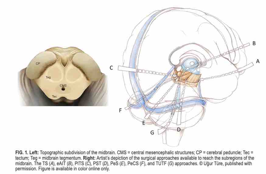 Microsurgical management of midbrain gliomas: surgical results and long-term outcome in a large, single-surgeon, consecutive series. thejns.org/view/journals/….